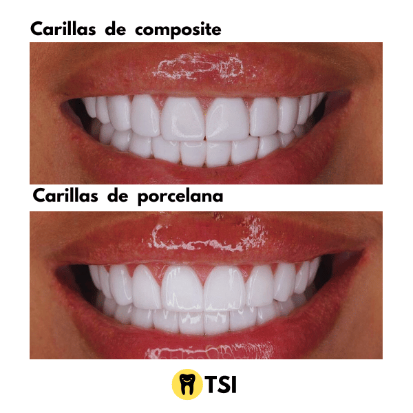 Carillas composite vs porcelana