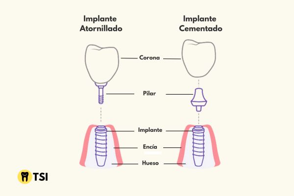 Implante Cementado Grafico