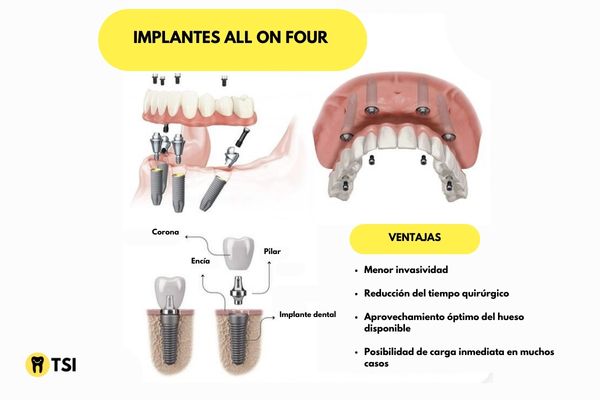 Implantes All On Four