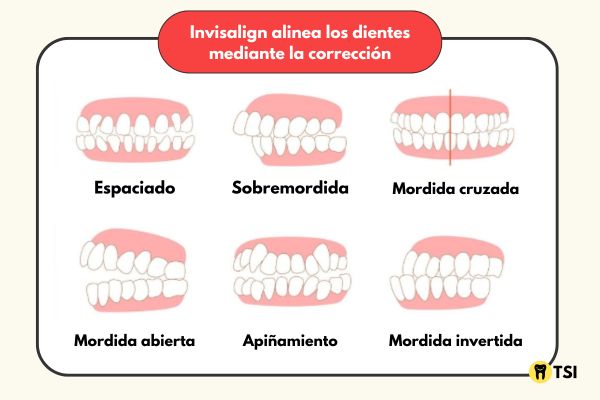 Invisalign alinea los dientes