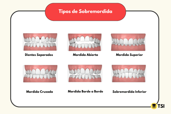 TIPOS DE SOBREMORDIDA