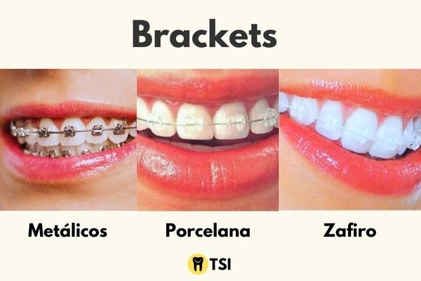 Tipo de Brackets