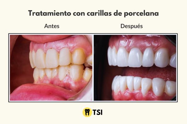 Tratamiento con carillas de porcelana