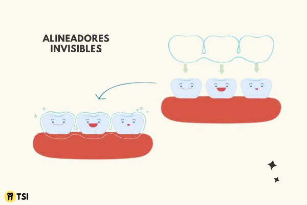 alineadores invisibles 1