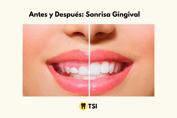 antes y despues sonrisa gingival