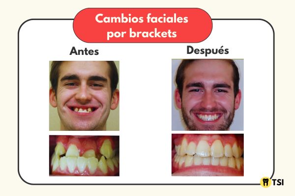 cambios faciales por brackets antes despues