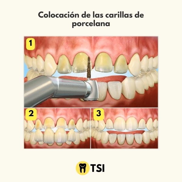 colocacion de las carillas dentales de porcelana