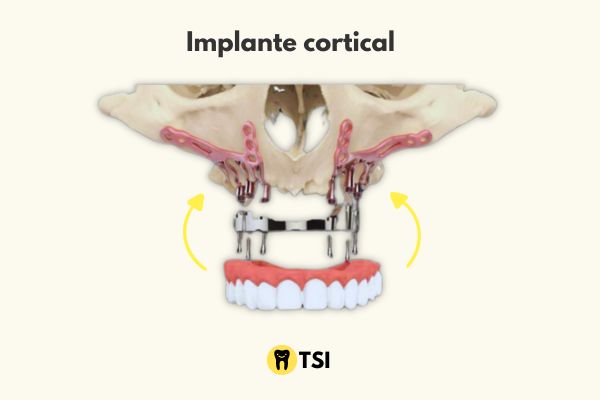 implante cortical