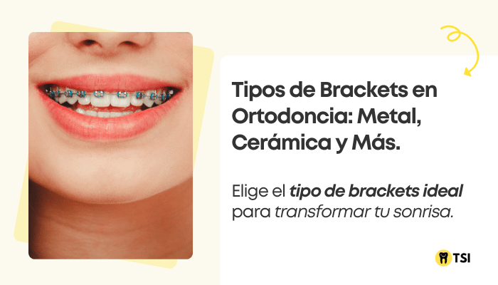 tipos de brackets en ortodoncia metal ceramica y mas