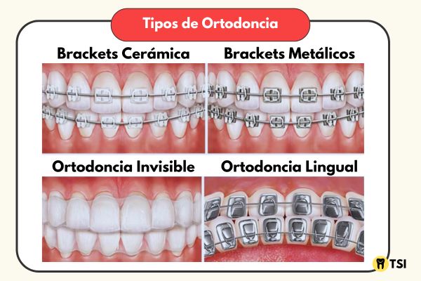 tipos de ortodoncia 1