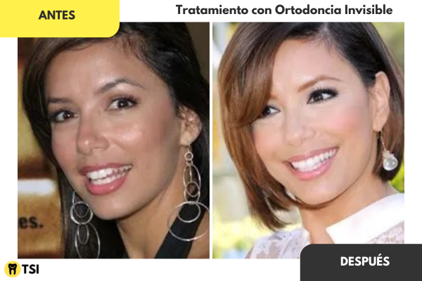 Antes y despues Invisalign 1