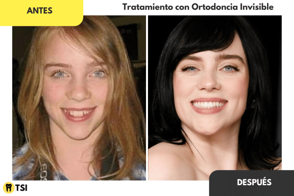 Antes y despues Invisalign 2