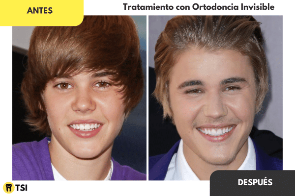 Antes y despues Invisalign 5