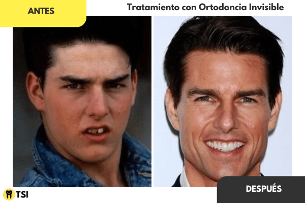 Antes y despues Invisalign 6