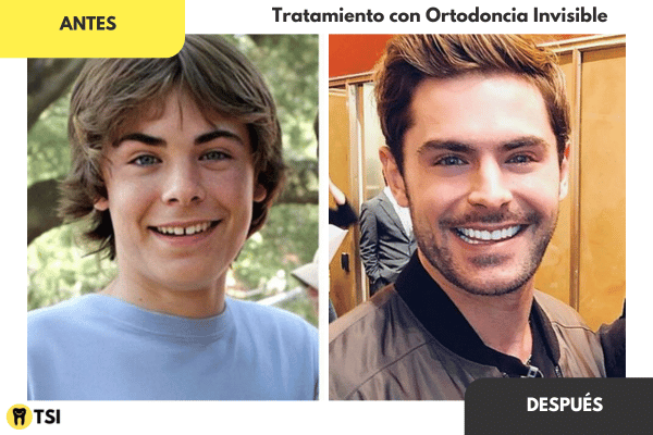 Antes y despues Invisalign 7