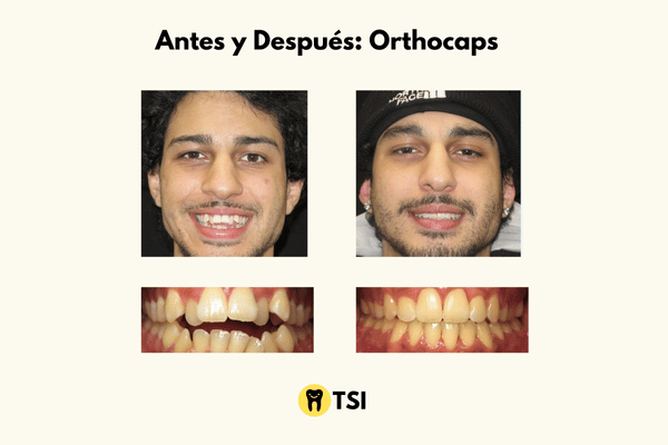 Antes y despues Orthocaps