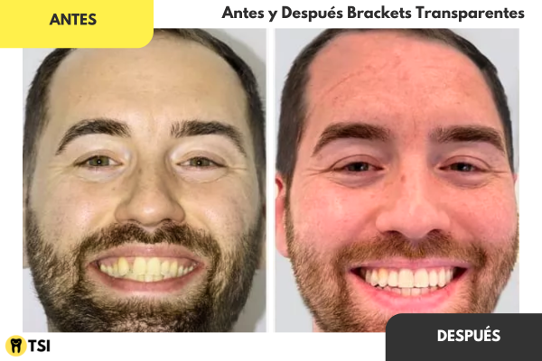 antes y despues brackets transparentes