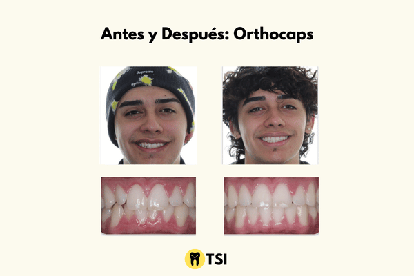 antes y despues de orthocaps