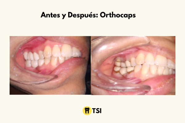 antes y despues usando orthocap