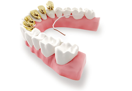 brackets linguales