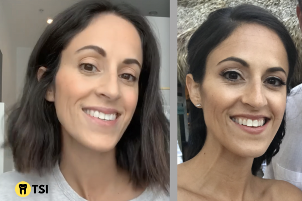 crossbite before and after 1