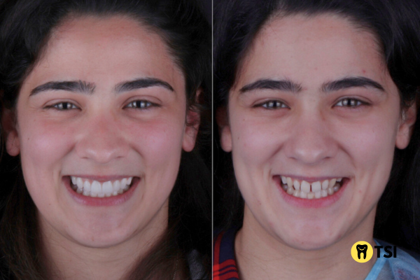 diastema antes y despues