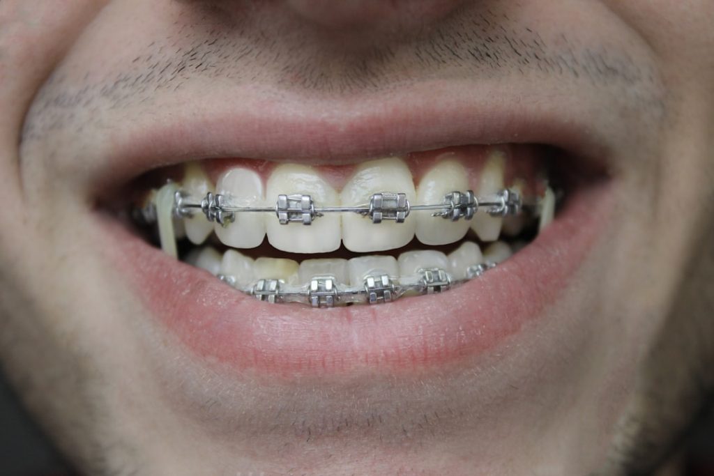 hombre usando brackets autoligables