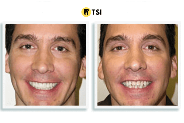 mordida abierta antes y despues