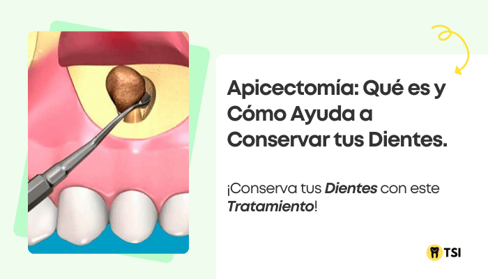 apicectomia-que-es-y-como-ayuda-a-conservar-tus-dientes