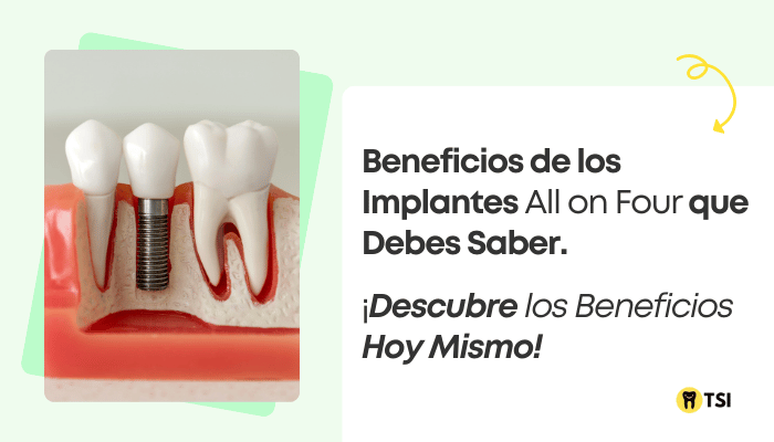 beneficios-de-los-implantes-all-on-four