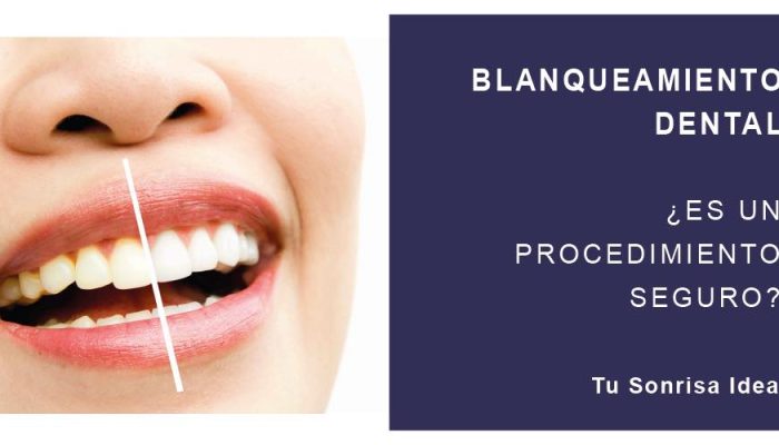 blanqueamiento-dental