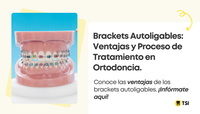 brackets-autoligables-ventajas-y-proceso-de-tratamiento-en-ortodoncia