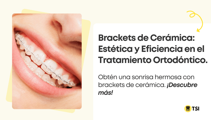 brackets-de-ceramica-estetica-y-eficiencia-en-el-tratamiento-ortodontico