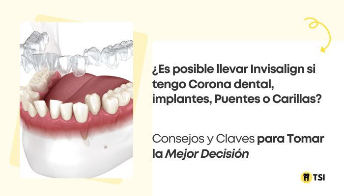 carillas dentales implantes con invisalign