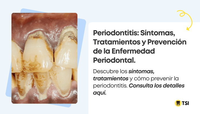 periodontitis-sintomas-tratamientos-y-prevencion-de-la-enfermedad-periodontal