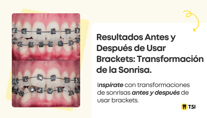 resultados-antes-y-despues-de-usar-brackets-transformacion-de-la-sonrisa