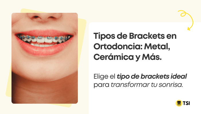 tipos-de-brackets-en-ortodoncia-metal-ceramica-y-mas